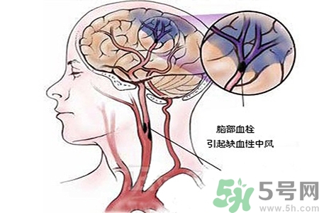 腦出血的治療方法是什么？腦出血可以用哪些藥物治療？