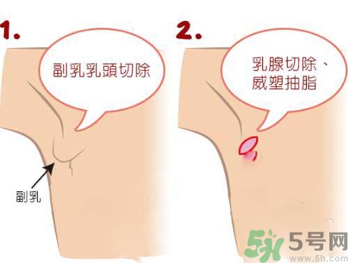 副乳是什么？副乳的危害