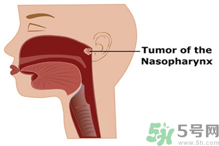 鼻咽癌的高發(fā)人群有哪些？如何預(yù)防鼻咽癌？
