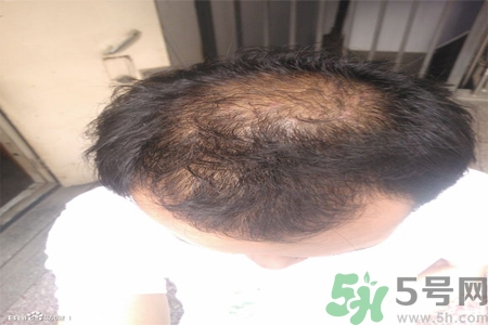 脫發(fā)的措施有什么？脫發(fā)的注意飲食有哪些？