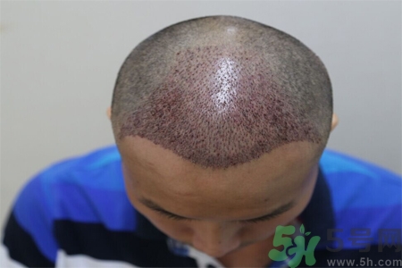 脫發(fā)的原因是什么？脫發(fā)會(huì)引發(fā)什么疾病？