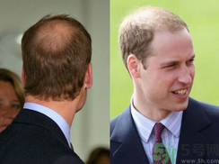 男人禿頂是什么原因？男人禿頂怎么辦？