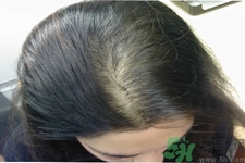 脫發(fā)的治療方法是什么？脫發(fā)的藥物治療有哪些？