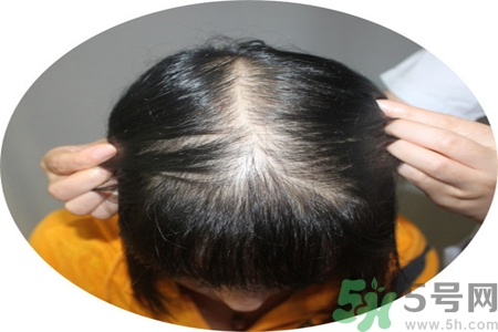 脫發(fā)的治療方法是什么？脫發(fā)的藥物治療有哪些？