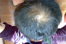 脫發(fā)的高發(fā)人群有哪些？如何預(yù)防脫發(fā)？