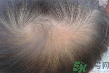 脫發(fā)的高發(fā)人群有哪些？如何預(yù)防脫發(fā)？