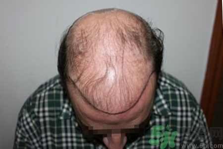 脫發(fā)會(huì)遺傳嗎？脫發(fā)遺傳可以治療嗎？