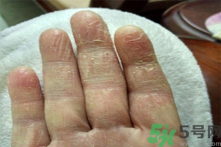 手足癬是什么？手足癬癥狀有什么？