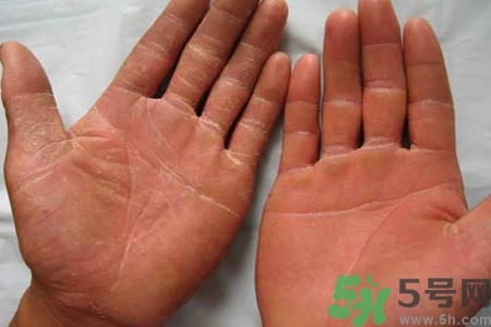 手足癬是什么？手足癬癥狀有什么？