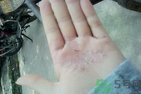 引起手足癬的主要原因？手足癬會(huì)引發(fā)什么疾病？