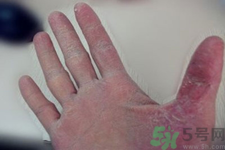 引起手足癬的主要原因？手足癬會(huì)引發(fā)什么疾??？