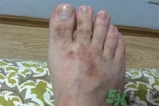 手足癬的治療方法？治療手足癬可以用什么藥？