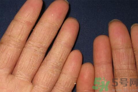 手足癬的治療方法？治療手足癬可以用什么藥？