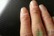 手足癬的治療方法？治療手足癬可以用什么藥？