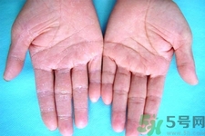 手足癬的治療方法？治療手足癬可以用什么藥？