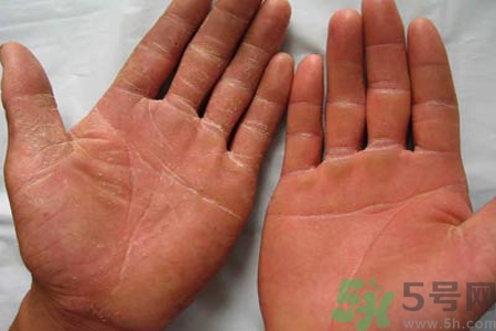 手足癬的治療方法？治療手足癬可以用什么藥？