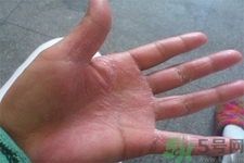 手足癬的易發(fā)人群有哪些？如何預防手足癬？