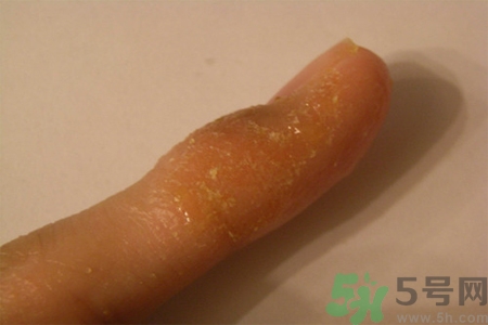 手足癬的易發(fā)人群有哪些？如何預防手足癬？