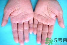 手足癬預(yù)防措施需要注意什么？手足癬飲食要注意哪些？