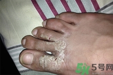 手足癬預(yù)防措施需要注意什么？手足癬飲食要注意哪些？