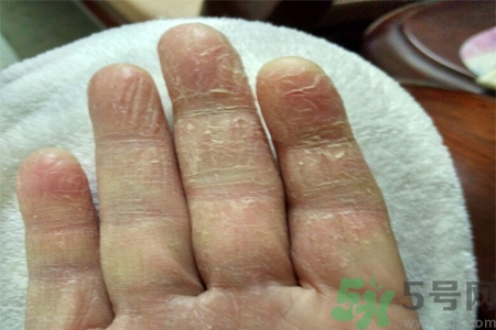 手足癬會傳染嗎？手足癬的傳播途徑有哪些？