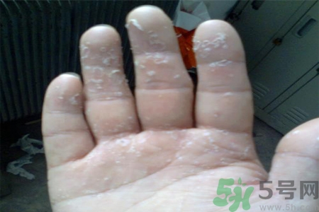 手足癬會傳染嗎？手足癬的傳播途徑有哪些？