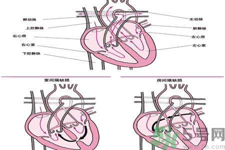 先天性心臟病是什么？先天性心臟病的癥狀有哪些？