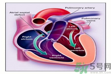 先天性心臟病發(fā)病原因是什么？