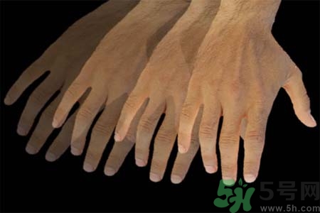 帕金森是什么？帕金森的癥狀有哪些？