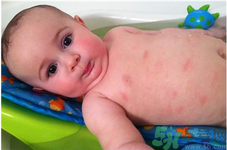 寶寶秋季過敏性皮炎是什么引起的？寶寶秋季過敏性皮炎的預(yù)防及治療