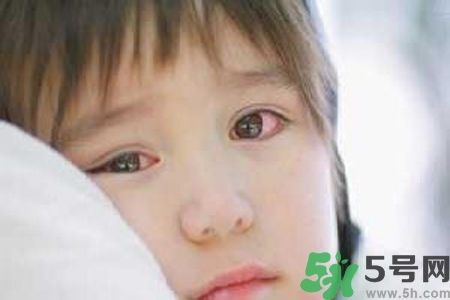 寶寶為什么會感染紅眼?。繉殞毣技t眼病如何治療？