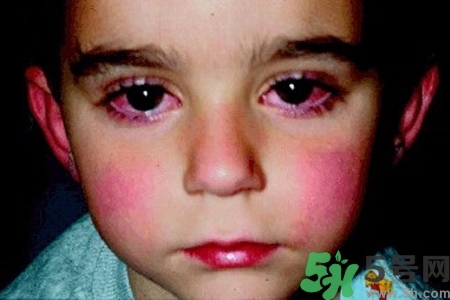 寶寶為什么會感染紅眼??？寶寶患紅眼病如何治療？