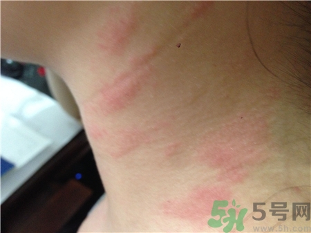 為什么露天游泳后全身紅腫出水皰? 為什么露天游泳后全身紅腫出水皰?