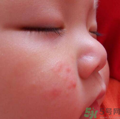 寶寶長蘚是怎么回事？寶寶長蘚怎么辦？