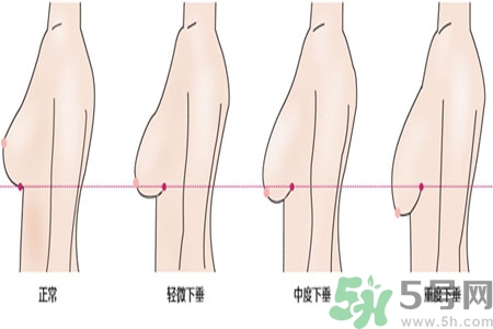 ?女性乳房下垂的原因是什么？女性乳房下垂的分類(lèi)有哪些？