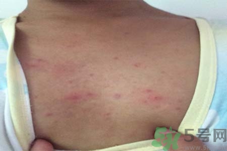 胸部長痘痘怎么回事？胸部長痘痘的原因是什么？