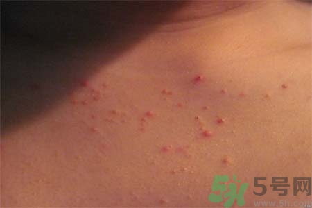 胸部長痘痘怎么回事？胸部長痘痘的原因是什么？