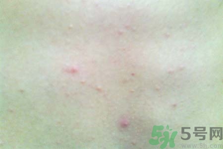 胸部長痘痘怎么辦？胸部長痘痘需要注意什么？