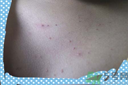 胸部長痘痘怎么辦？胸部長痘痘需要注意什么？