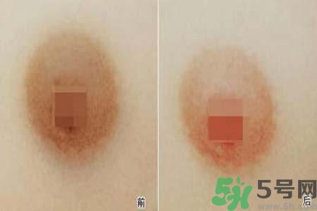 乳頭發(fā)黑怎么辦？怎么樣可以使乳頭變白？
