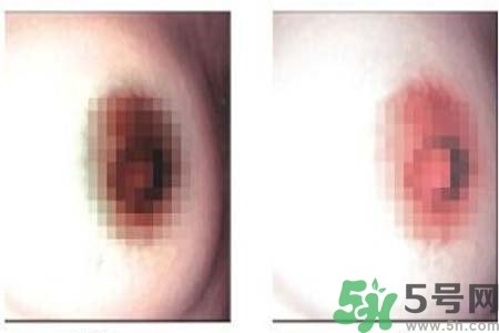 乳頭發(fā)黑怎么辦？怎么樣可以使乳頭變白？