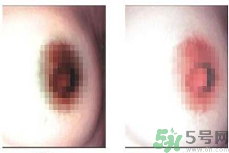 乳頭發(fā)黑是怎么回事？乳頭發(fā)黑是什么原因？