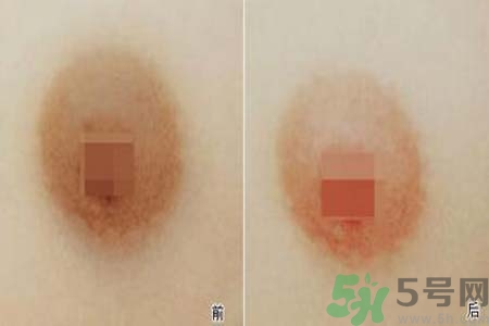 乳頭發(fā)黑是怎么回事？乳頭發(fā)黑是什么原因？
