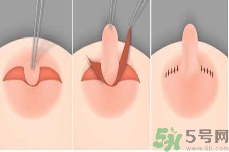 乳頭內(nèi)陷怎么回事？乳頭內(nèi)陷的原因是什么？