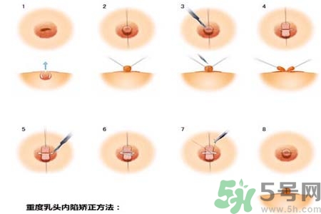 乳頭內(nèi)陷怎么回事？乳頭內(nèi)陷的原因是什么？