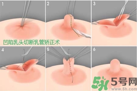 乳頭內(nèi)陷怎么辦？乳頭內(nèi)陷的癥狀有哪些？