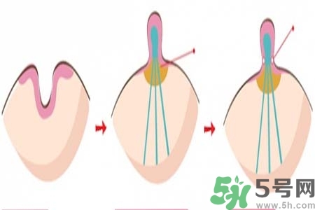 乳頭內(nèi)陷怎么辦？乳頭內(nèi)陷的癥狀有哪些？