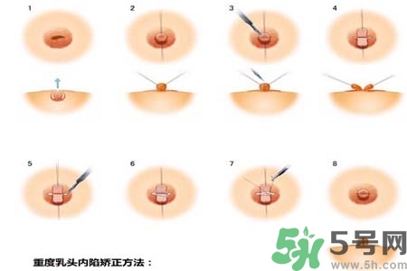 乳頭內(nèi)陷怎么辦？乳頭內(nèi)陷的癥狀有哪些？