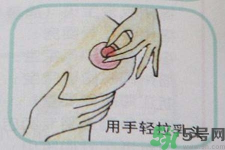 乳頭內(nèi)陷怎么辦？乳頭內(nèi)陷的癥狀有哪些？
