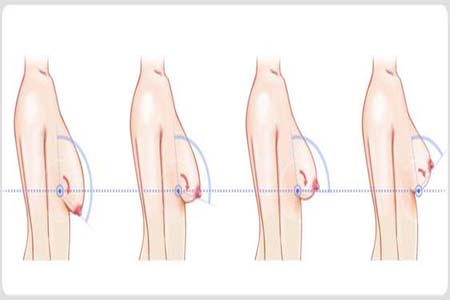 胸部松弛的原因是什么？胸部松弛該怎么辦？